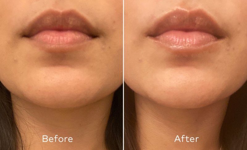 Can Hyaluronic Acid and Vaseline Really Replace Lip Fillers?